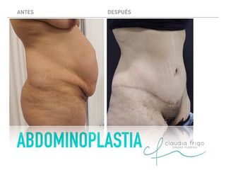 Antes y después de una Abdominoplastia