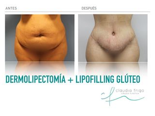 Abdominoplastia - Dra. Claudia Frigo