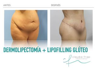 Abdominoplastia - Dra. Claudia Frigo