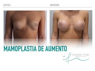 Aumento de pecho - Dra. Claudia Frigo