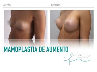 Aumento de pecho - Dra. Claudia Frigo