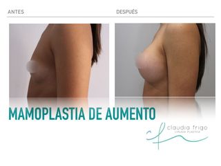 Aumento de pecho - Dra. Claudia Frigo
