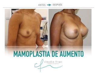 Aumento de pecho - Dra. Claudia Frigo