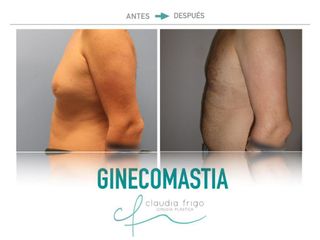 Ginecomastia - Dra. Claudia Frigo