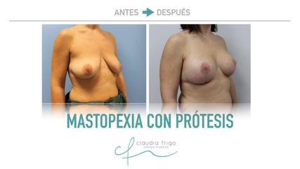 Mastopexia - Dra. Claudia Frigo