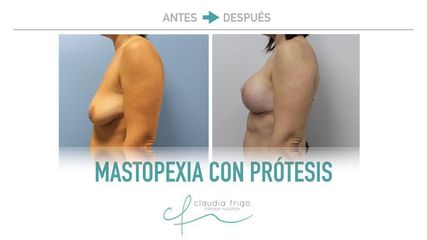 Mastopexia - Dra. Claudia Frigo