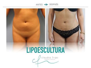 Lipoescultura - Dra. Claudia Frigo
