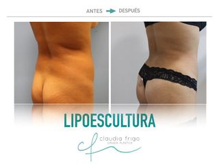 Lipoescultura - Dra. Claudia Frigo