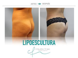 Lipoescultura - Dra. Claudia Frigo