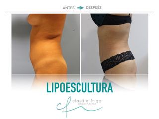 Lipoescultura - Dra. Claudia Frigo