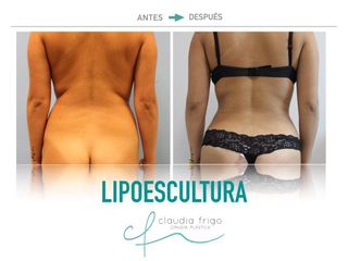 Lipoescultura - Dra. Claudia Frigo