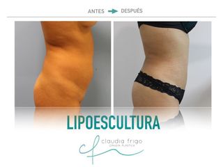 Lipoescultura - Dra. Claudia Frigo