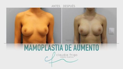 Aumento de pecho - Dra. Claudia Frigo