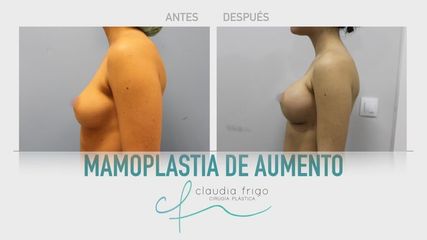 Aumento de pecho - Dra. Claudia Frigo