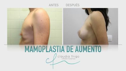 Aumento de pecho - Dra. Claudia Frigo