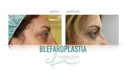 Blefaroplastia - Dra. Claudia Frigo