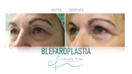 Blefaroplastia - Dra. Claudia Frigo