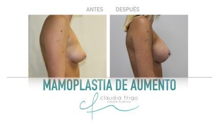 Aumento de pecho - Dra. Claudia Frigo