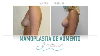 Aumento de pecho - Dra. Claudia Frigo