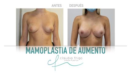 Aumento de pecho - Dra. Claudia Frigo