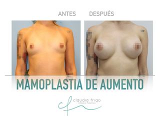 Aumento de pecho - Dra. Claudia Frigo