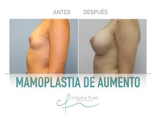 Aumento de pecho - Dra. Claudia Frigo