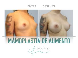 Aumento de pecho - Dra. Claudia Frigo