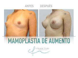 Aumento de pecho - Dra. Claudia Frigo