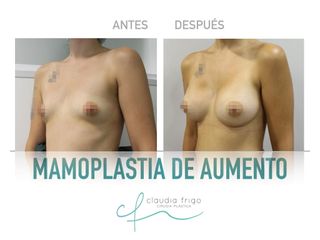 Aumento de pecho - Dra. Claudia Frigo