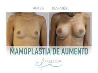 Aumento de pecho - Dra. Claudia Frigo