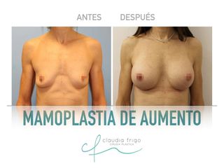 Aumento de pecho - Dra. Claudia Frigo