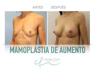 Aumento de pecho - Dra. Claudia Frigo