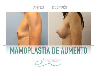 Aumento de pecho - Dra. Claudia Frigo