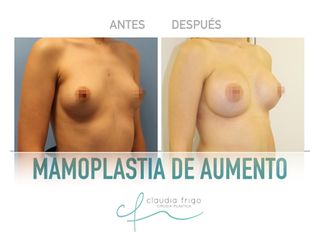 Aumento de pecho - Dra. Claudia Frigo