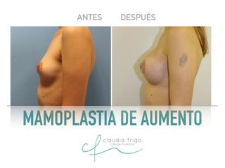 Aumento de pecho - Dra. Claudia Frigo