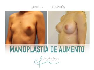 Aumento de pecho - Dra. Claudia Frigo