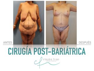 Lipoescultura - Dra. Claudia Frigo