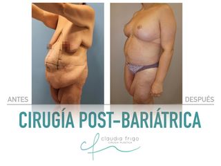 Lipoescultura - Dra. Claudia Frigo