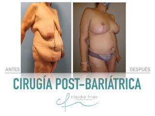 Lipoescultura - Dra. Claudia Frigo