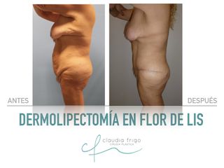Lipoescultura - Dra. Claudia Frigo