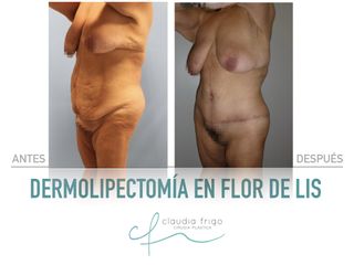 Lipoescultura - Dra. Claudia Frigo