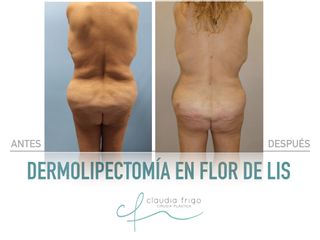 Lipoescultura - Dra. Claudia Frigo