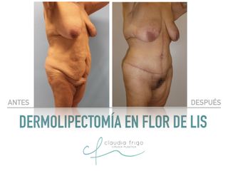 Lipoescultura - Dra. Claudia Frigo