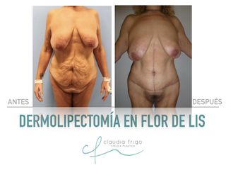 Lipoescultura - Dra. Claudia Frigo