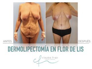 Lipoescultura - Dra. Claudia Frigo