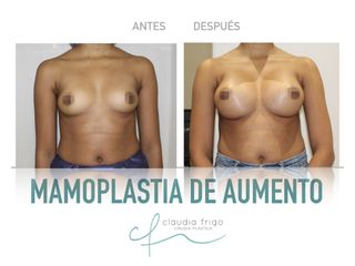 Aumento de pecho - Dra. Claudia Frigo