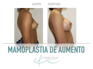 Aumento de pecho - Dra. Claudia Frigo