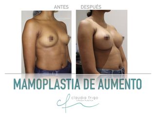 Aumento de pecho - Dra. Claudia Frigo