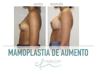 Aumento de pecho - Dra. Claudia Frigo