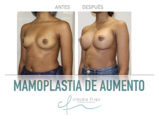 Aumento de pecho - Dra. Claudia Frigo